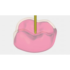 Exocad Provisional module (temporary crowns)