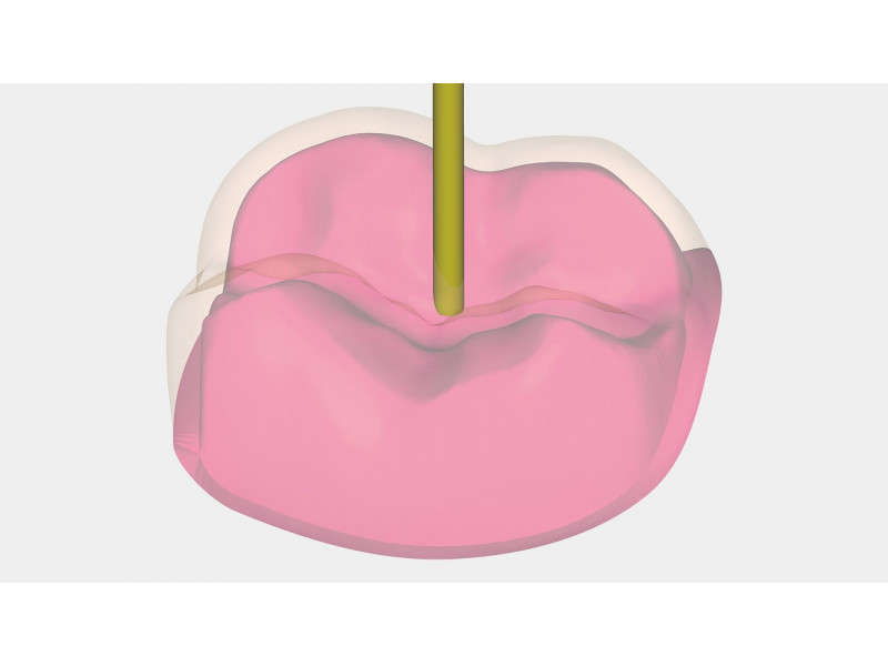 Exocad Provisional module (temporary crowns)